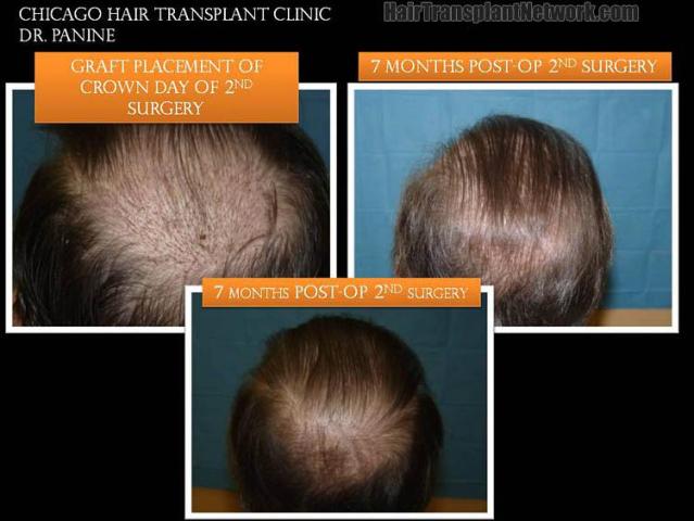 Before and after surgical hair restoration images