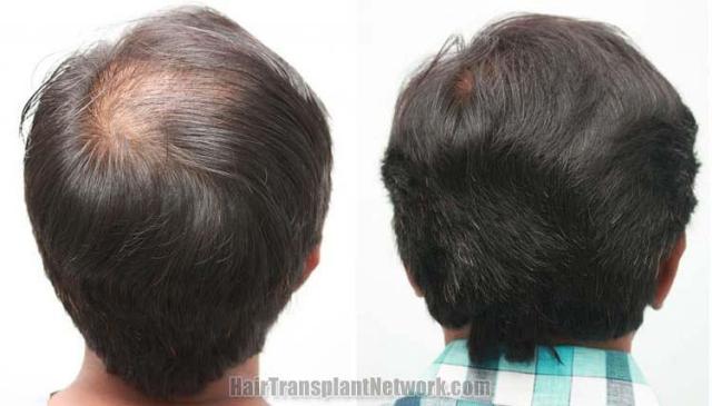 Back view before and after hair transplantation photos