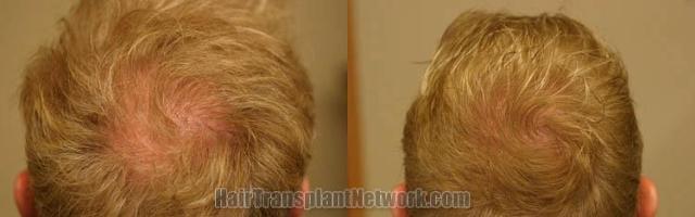 Hair restoration procedure before and after pictures