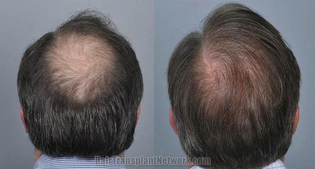 Hair restoration procedure before and after pictures