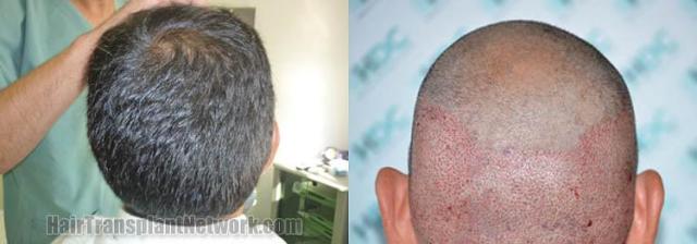 Hair restoration procedure before and after pictures