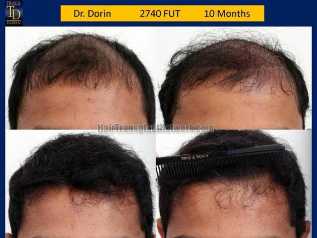 Hair restoration procedure before and after results