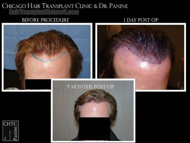 Hair restoration procedure before and after results