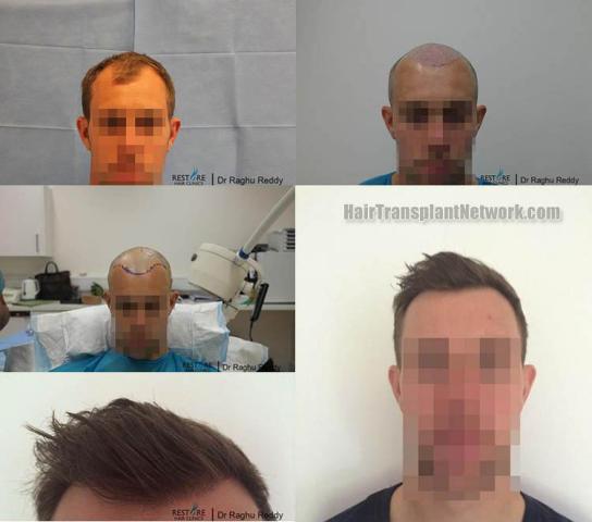 Before and after hair transplant procedure images