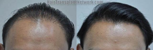 Hair restoration procedure before and after results