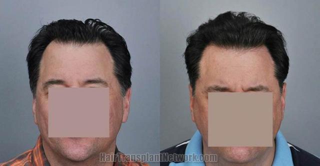 Before and after hair transplantation result photographs