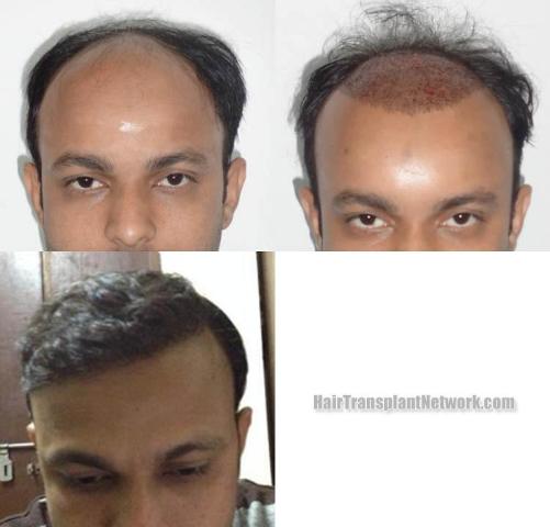 Hair restoration procedure before and after results