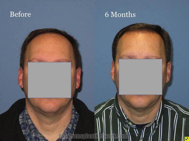 Hair restoration procedure before and after results