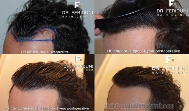 Hair restoration surgery before and after photos