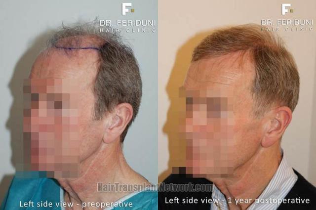 Hair transplantation surgery before and after images