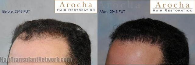 Hair restoration procedure before and after results