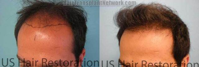 Hair transplantation surgery before and after images