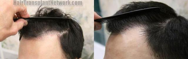 Hair transplantation surgery before and after images