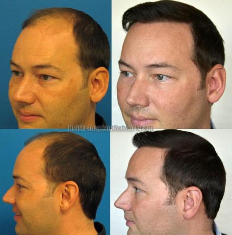 Hair transplantation surgery before and after pictures