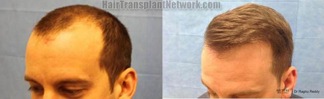 Hair restoration procedure before and after pictures