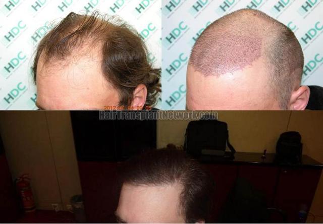 Hair restoration procedure before and after pictures