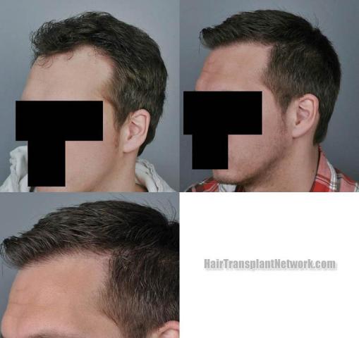 Hair transplantation surgery before and after pictures