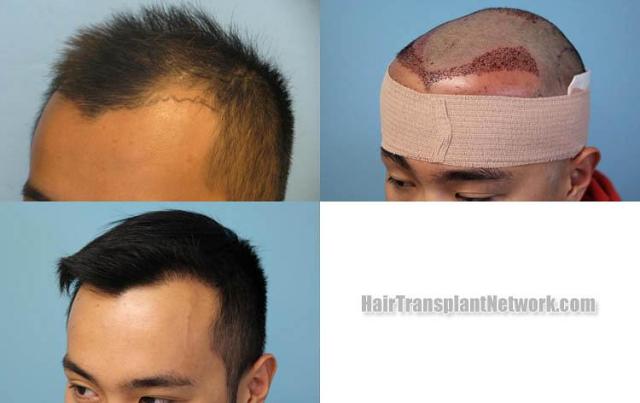 Hair transplantation surgery before and after photos