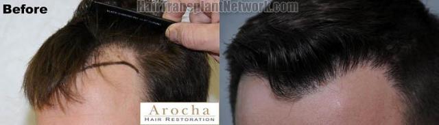 Hair transplantation surgery before and after images