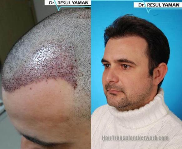 Hair transplantation surgery before and after photos