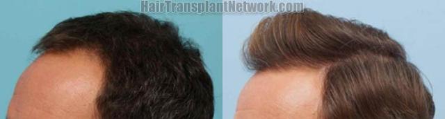 Hair transplantation surgery before and after pictures