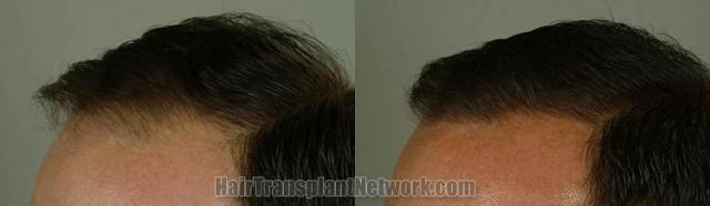 Hair transplantation surgery before and after photos