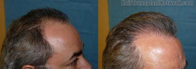 Hair replacement surgery procedure pictures - Right view