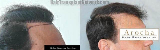 Hair restoration correction surgery to repair old plugs