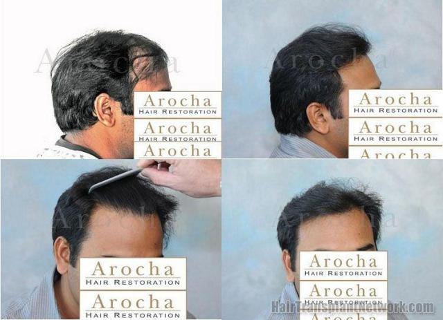 Right side hair restoration before and after results