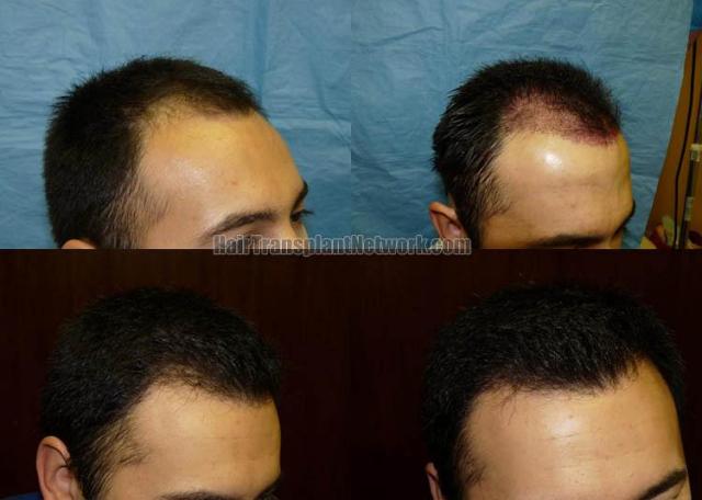 Before and after hair transplantation procedure photos