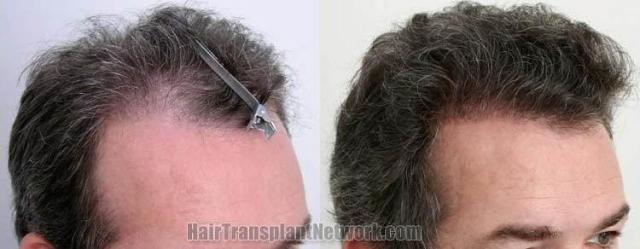 Right view before and after hair transplantation picture