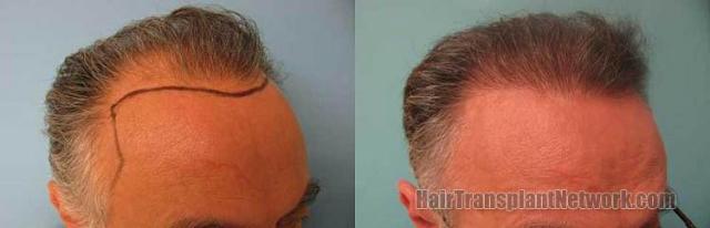 Hair transplantation surgery before and after photos