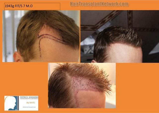 Hair restoration procedure before and after results