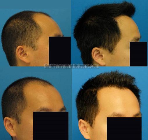 Hair transplantation surgery before and after images