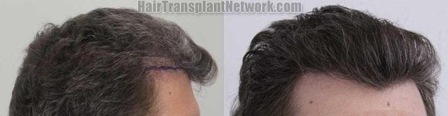 Hair transplantation surgery before and after images