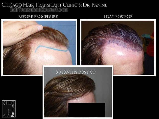 Hair transplantation surgery before and after photos