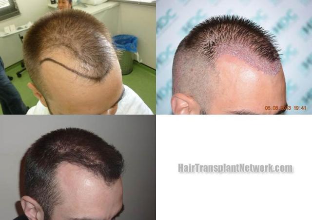 Hair transplantation surgery before and after images