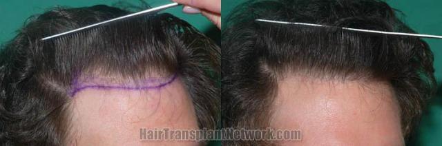 Hair transplantation surgery before and after images