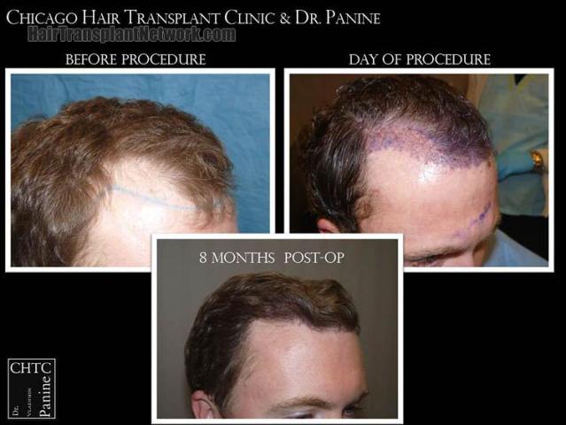 Hair transplantation surgery before and after images