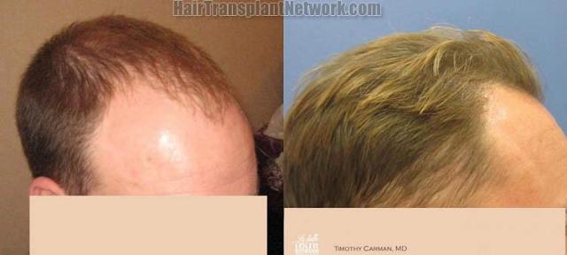 Hair transplantation surgery before and after photos