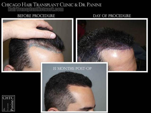 Hair transplantation surgery before and after photos