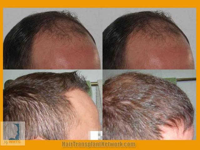 Hair transplantation surgery before and after images