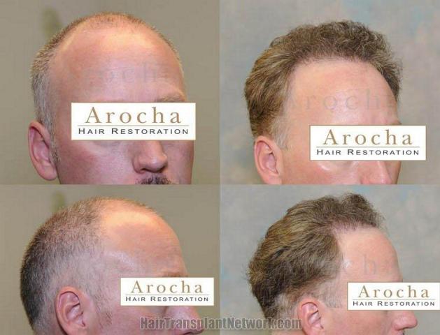 Right view - before and after hair transplant