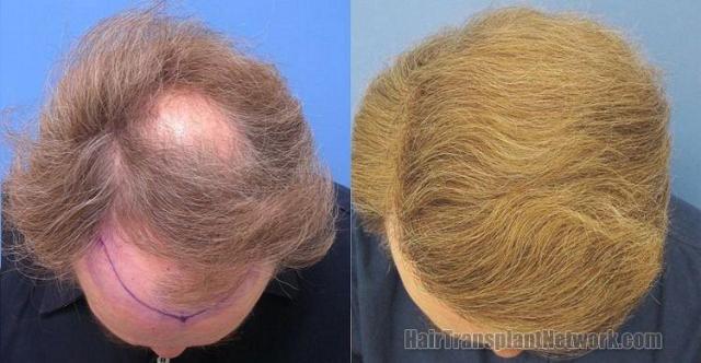 Photos of  top view showing hair restoration results