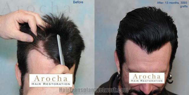 Before and after hair transplant procedure images