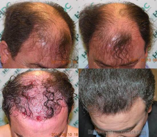 Hair restoration procedure before and after results