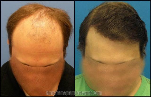 Top view before and after hair restoration results