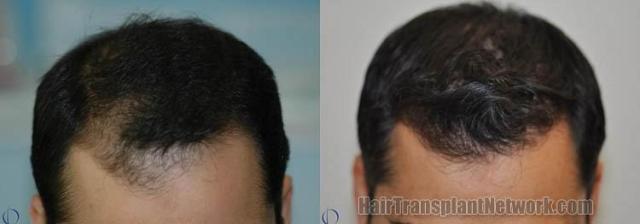 Top view before and after hair restoration results