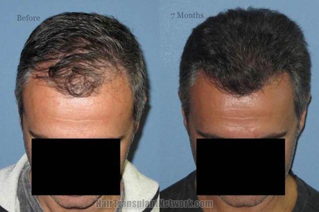 Hair transplantation surgery before and after photos