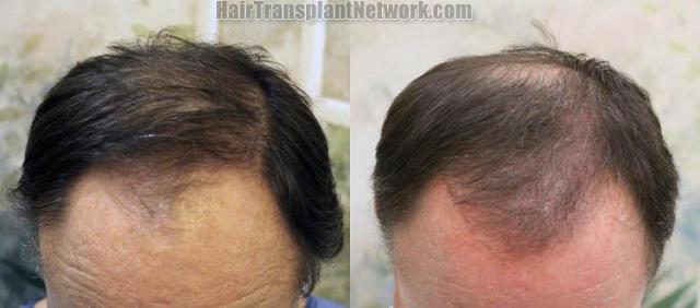 Hair transplantation surgery before and after photos